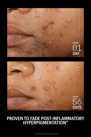 Azelaic & Kojic Advanced Clarifying Serum