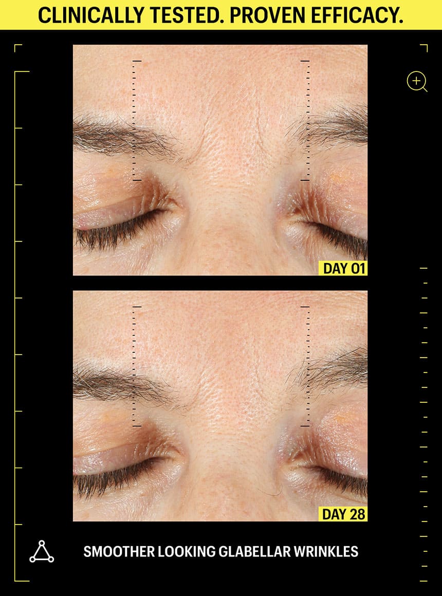 retinol wrinkles before and after
