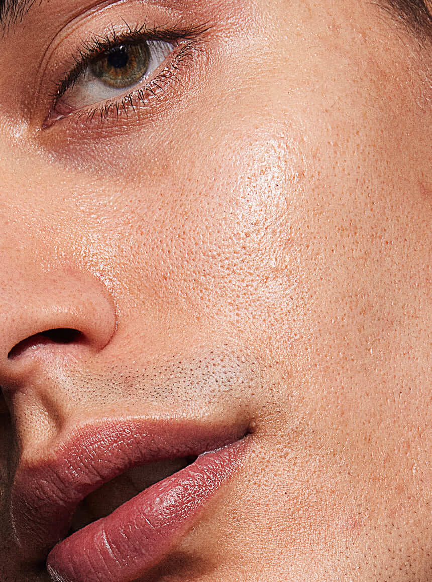 mandelic acid hyperpigmentation